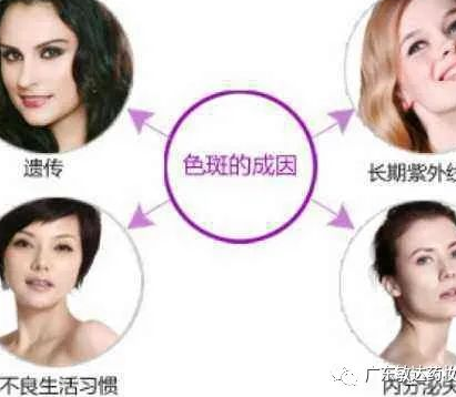 我们脸上为什么会长斑呢？激光祛斑到底靠不靠谱？